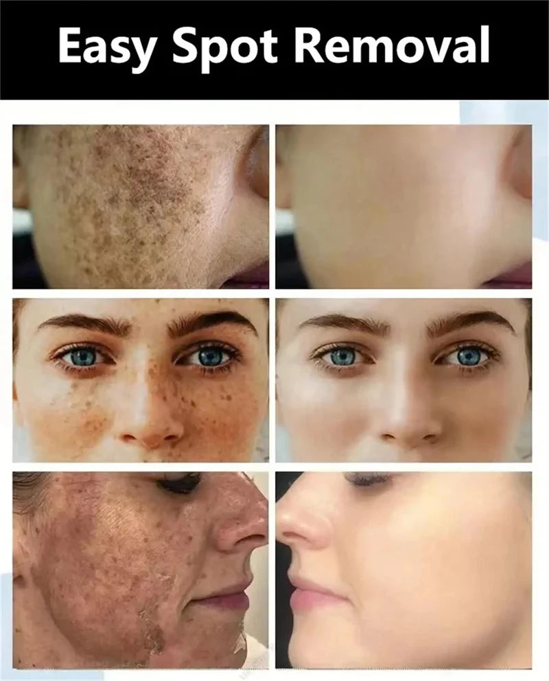 Dark Spots Remover Whitening Serum Face Freckle Melanin Correcting Anti Pigmentation Brightening