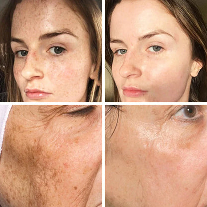 Dark Spots Remover Whitening Serum Face Freckle Melanin Correcting Anti Pigmentation Brightening