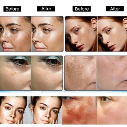 Dark Spots Remover Whitening Serum Face Freckle Melanin Correcting Anti Pigmentation Brightening