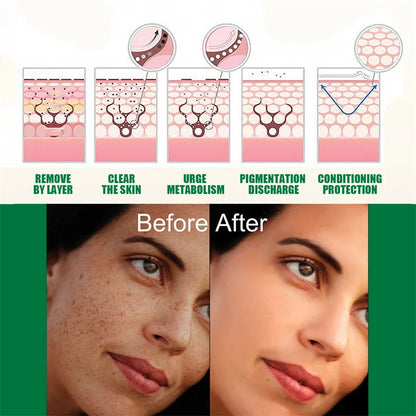 Dark Spots Remover Whitening Serum Face Freckle Melanin Correcting Anti Pigmentation Brightening