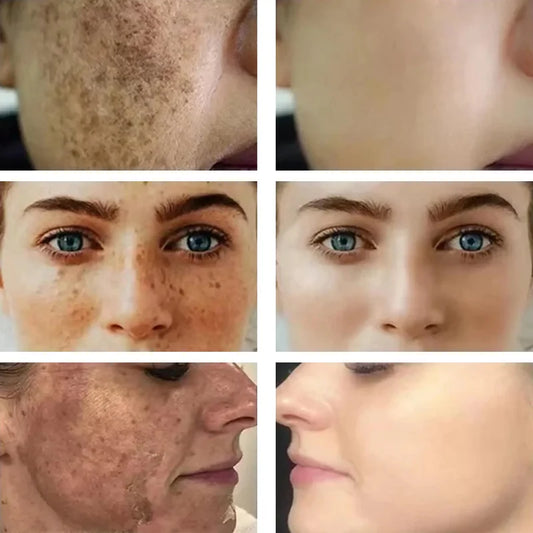 Dark Spots Remover Whitening Serum Face Freckle Melanin Correcting Anti Pigmentation Brightening